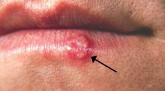 How a cold sore looks like