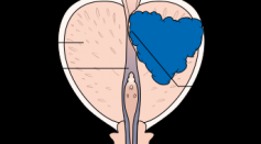 A diagram of prostate cancer pressing on the urethra, which can cause symptoms