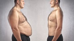 Bariatric surgery is often the last resort to treat very obese patients