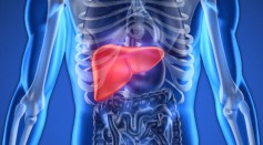 Non-alcoholic steatohepatitis (NASH) is a non-alcohol intake-related liver inflammation 