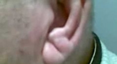 Diagonal Ear Lobes Crease May Indicate Higher Risk of Stroke