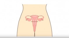 Depending on the size and location of the Uterine Fibroids, pregnancy is said to still be possible.