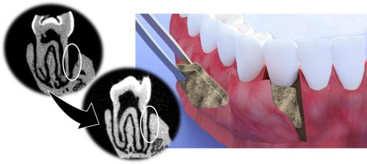 New membrane class shown to regenerate tissue and bone ...