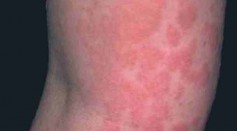 Allergic Rashes