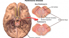 Parkinson's Disease