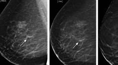 Breast Cancer Is Detected Better With Machine AI and More Accurate Than Human Doctors