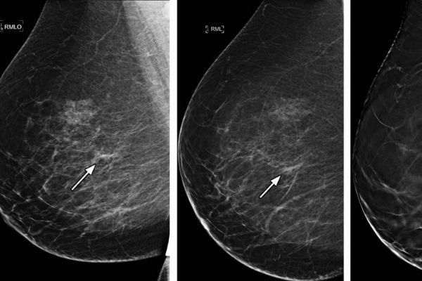 Breast Cancer Is Detected Better With Machine AI and More Accurate Than Human Doctors