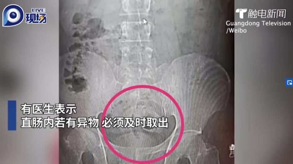 Gruesome Video Doctors Remove A Blue Tilapia From A Chinese Mans