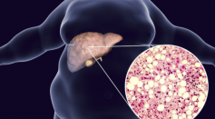 First-of-its-Kind Antisense Drug May Become Novel Treatment for Fatty Liver Disease