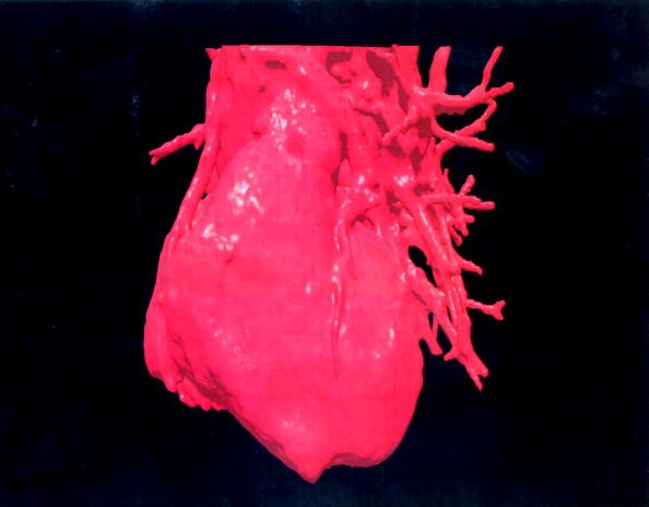 Three Dimensional Visualization Of A Human Heart