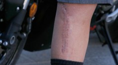 Skin Study Gives Insight on How Wounds Heal