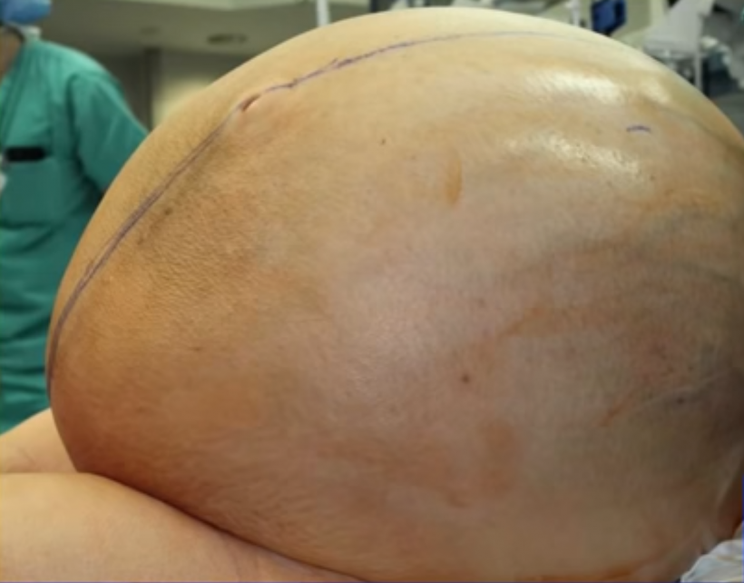 World's Largest Ovarian Tumor Weighing 112 Pounds Successfully Removed From A Woman in India
