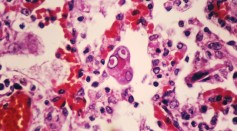 Simian measles pneumonia