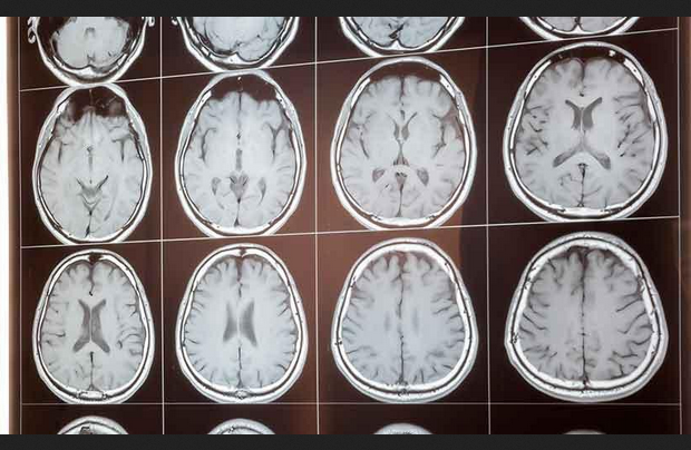 MRI Imaging Reveals Evidence of Dissociative Symptoms Linked to Childhood Trauma