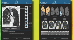 VIDA Diagnostis Inc. Receives FDA Clearance to Advance AI LungPrint Solution