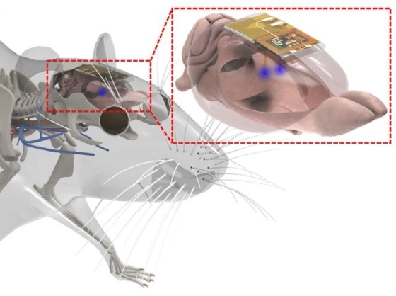  Therapeutic Wireless Rechargeable Tiny Brain Implant Can Be Controlled Using Smartphone
