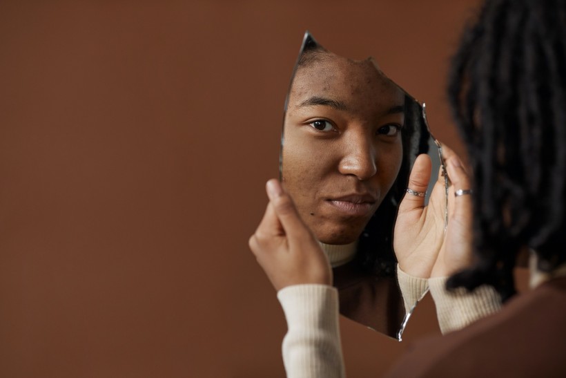 Science Times - People with Darker Skin, Likely to Suffer from Psychological Effects of Acne