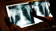 Science Times - Gene Variant’s Evolution Revealed; Scientists Show How People Become Vulnerable to Tuberculosis
