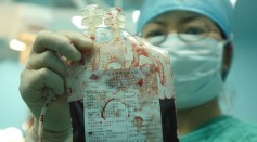 Doctors Preserve Umbilical Cord Blood To Save Leukemic Girl