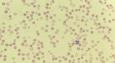 Dimorphic population of red blood cells.jpg