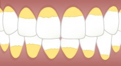  Plaque vs Tartar: Can Teeth Whitening Toothpaste Remove Them