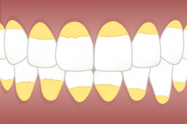  Plaque vs Tartar: Can Teeth Whitening Toothpaste Remove Them