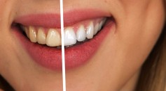  How to Make Teeth Whiter Instantly