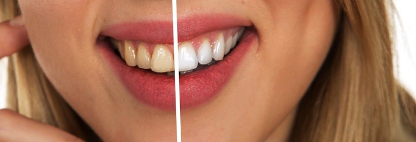 Science Times - Best Teeth Whitening Kit With Light That You Can Use At Home