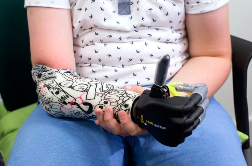 Nine Year Old Boy Is Fitted With A Bionic Arm