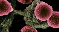  High Effectiveness of Immunotherapy Against Squamous Cell Carcinoma Leads to Better Outcomes