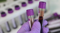 Groundbreaking Multi-Cancer Screening Blood Test Can Diagnose 50 Types of the Deadly Disease Even Before Symptoms Appear