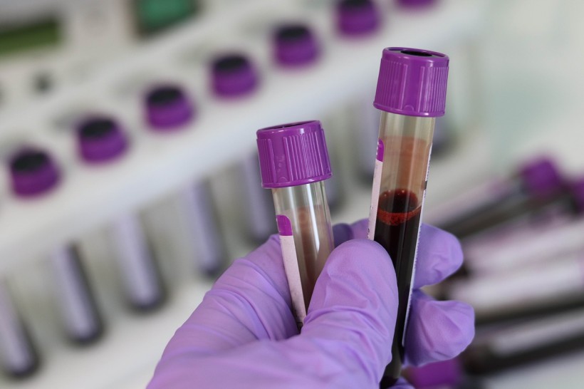 Groundbreaking Multi-Cancer Screening Blood Test Can Diagnose 50 Types of the Deadly Disease Even Before Symptoms Appear