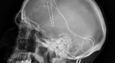Lateral X-ray of the head: Deep brain stimulation in obsessive–compulsive disorder (Medtronic 3391)