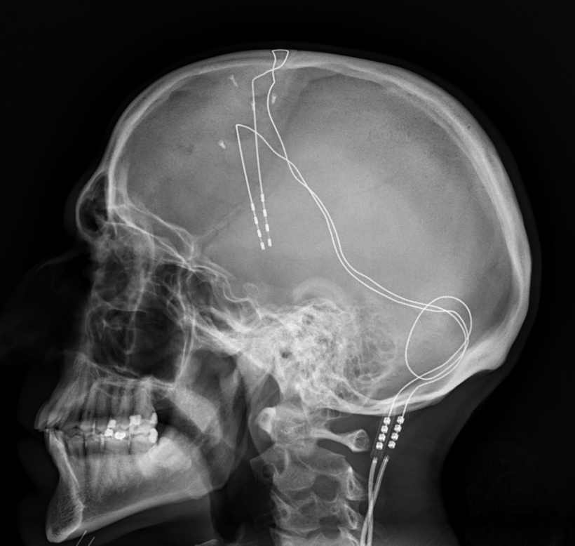 Lateral X-ray of the head: Deep brain stimulation in obsessive–compulsive disorder (Medtronic 3391)