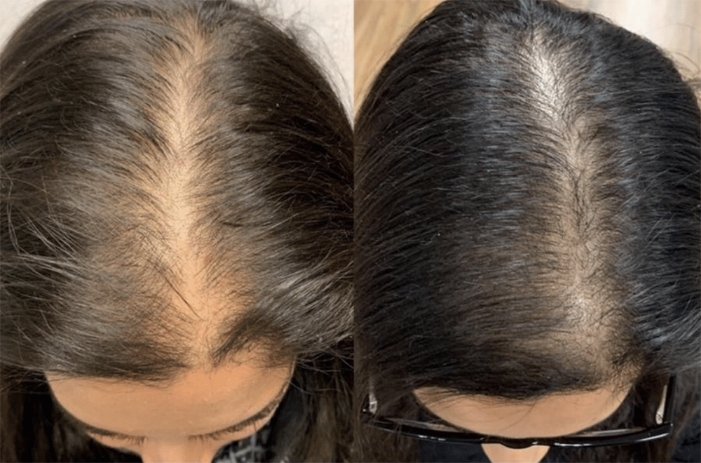 Suffering from Hair Loss? This Home Treatment Aims to Help | Science Times