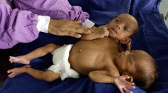 A nurse cares for conjoined twins at The Intensive Care Unit (ICU) of All India Institute of Medical Sciences (AIIMS