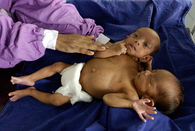 A nurse cares for conjoined twins at The Intensive Care Unit (ICU) of All India Institute of Medical Sciences (AIIMS