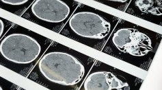 Science Times - Brain Illness Originally Thought as Human Prion Disease Occurring in Young People in Canada Remains Mystery to Doctors