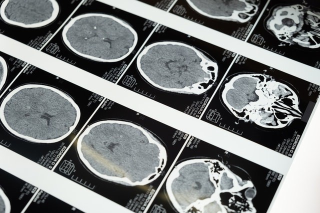 Science Times - Brain Illness Originally Thought as Human Prion Disease Occurring in Young People in Canada Remains Mystery to Doctors