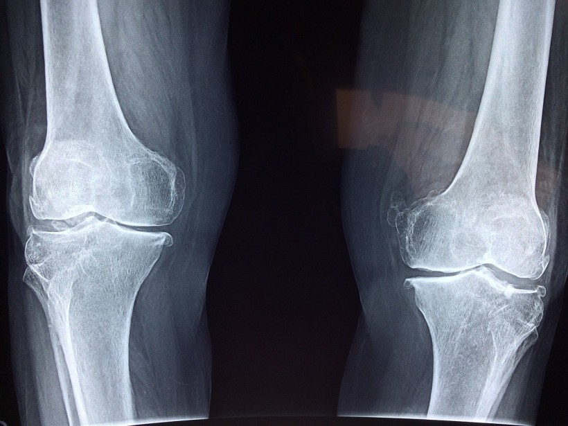  Arthritis Treatment: Knee Implant That Conducts Electric Current Stimulates Cartilage Regrowth to Heal Joints
