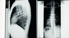 X-Ray Images of the Spine
