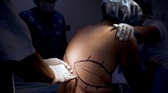 COLOMBIA-BEAUTY-HEALTH-SURGERY-POST BARIATRIC