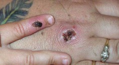 Monkey Pox Lesions