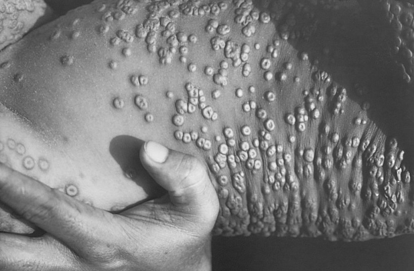 Smallpox Legions Are Shown In This 1973 Photograph In Bangladesh Drug Company Aventis Pa