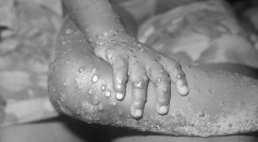  Living Through Monkeypox: Georgia Man Shares His Experience of Being Infected With the Once Rare Virus