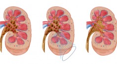 Comparison of different sized kidney stones in the human kidney. - stock illustration