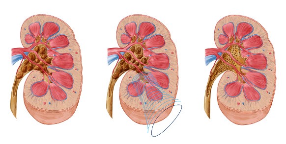 Comparison of different sized kidney stones in the human kidney. - stock illustration