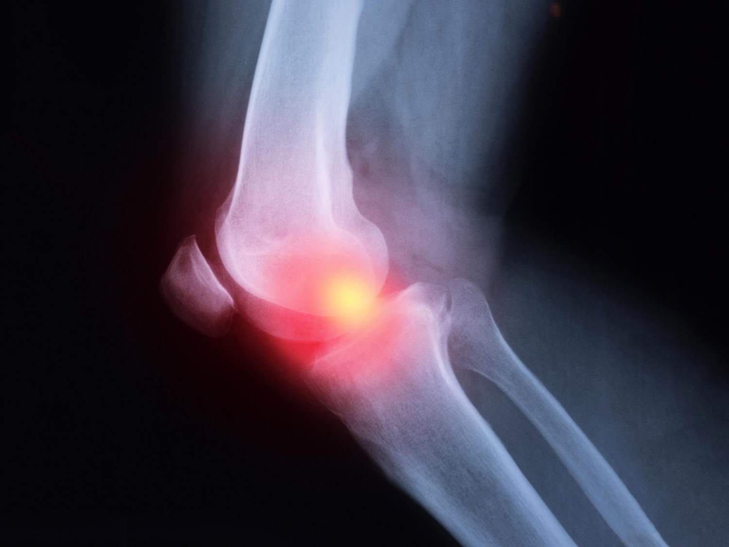 Ibuprofen, Naproxen, and Other Painkillers Can Aggravate Arthritis