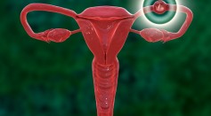 Ectopic pregnancy, illustration - stock illustration