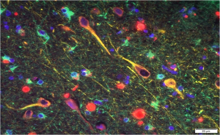 P. gingivalis' gingipains (red) among neurons in the brain of a patient with Alzheimer's. (Cortexyme)